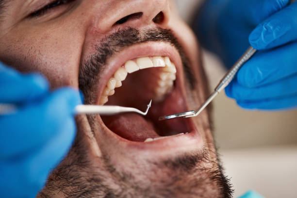 Best Emergency Dental Care for Broken or Chipped Teeth in Abingdon, MD