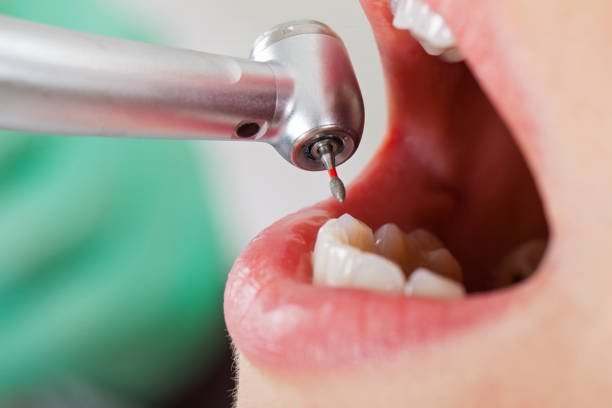 Best Emergency Tooth Extraction in Abingdon, MD